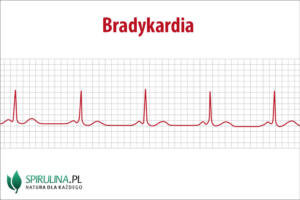 Bradykardia