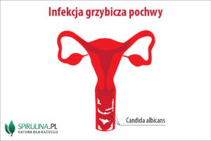 Infekcja grzybicza pochwy