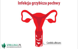 Infekcja grzybicza pochwy