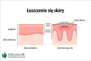 Łuszczenie się skóry