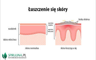 Łuszczenie się skóry