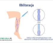 Obliteracja