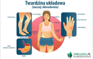 Twardzina układowa