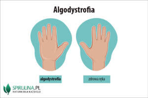 Algodystrofia