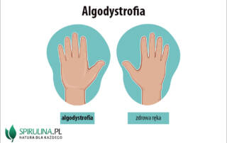 Algodystrofia