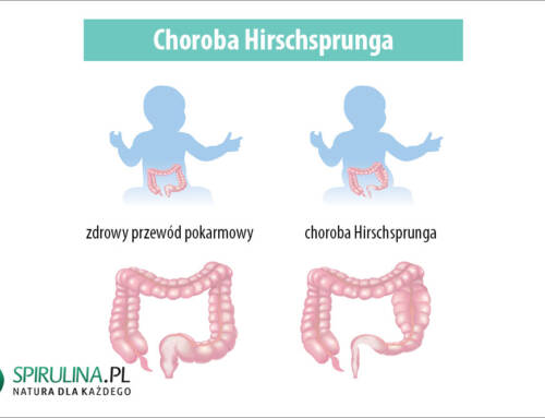 Choroba Hirschsprunga