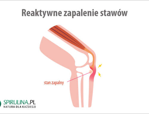 Reaktywne zapalenie stawów