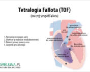 Tetralogia Fallota