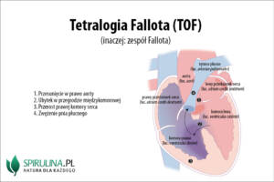 Tetralogia Fallota