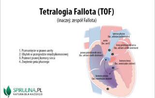 Tetralogia Fallota