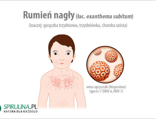 Rumień nagły