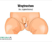 Wnętrostwo