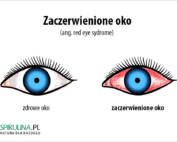 Zaczerwienione oko