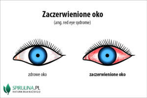 Zaczerwienione oko