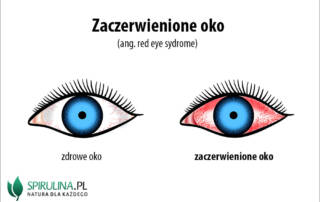 Zaczerwienione oko