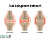 Brak kolagenu w kolanach