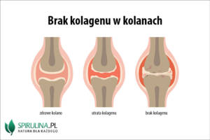 Brak kolagenu w kolanach