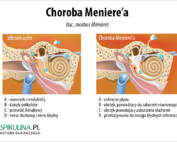 choroba meniere’a