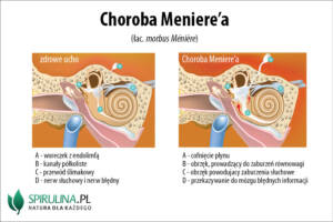 choroba meniere’a