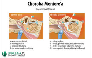 choroba meniere’a