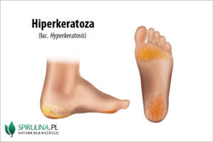 Hiperkeratoza