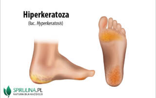 Hiperkeratoza