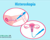 Histeroskopia