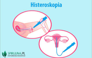 Histeroskopia