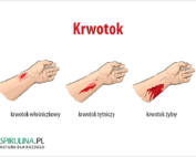 krwotok
