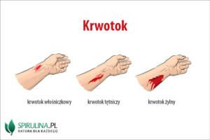 krwotok