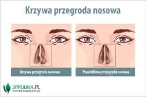 Krzywa przegroda nosowa