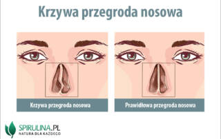 Krzywa przegroda nosowa