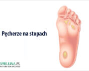 Pęcherze na stopach
