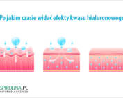 Po jakim czasie widać efekty kwasu hialuronowego?