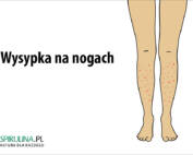 Wysypka na nogach