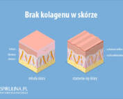 Brak kolagenu w skórze