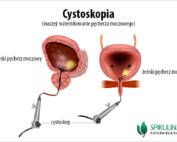 Cystoskopia