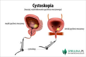 Cystoskopia