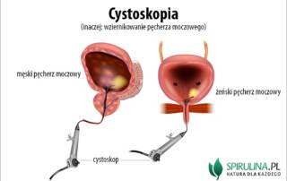 Cystoskopia