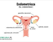 Endometrioza