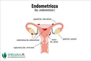 Endometrioza