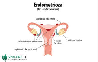 Endometrioza