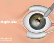 Keratoplastyka