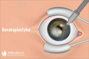 Keratoplastyka