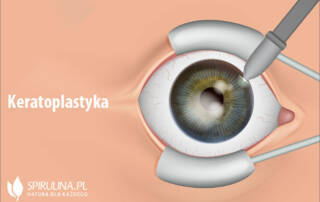 Keratoplastyka