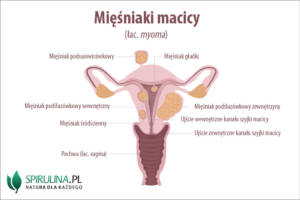 mięśniaki macicy