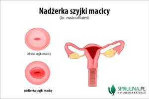 Nadżerka szyjki macicy