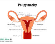 Polipy macicy