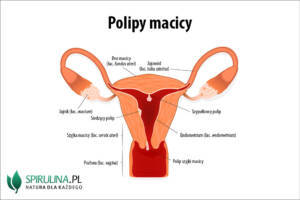 Polipy macicy