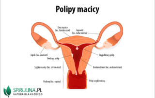 Polipy macicy